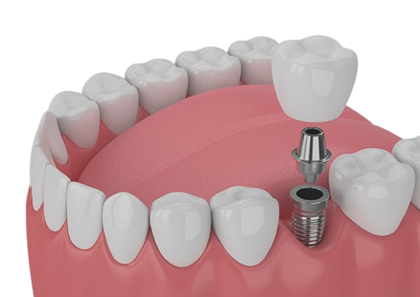 Single-Tooth-Implant-removebg-preview